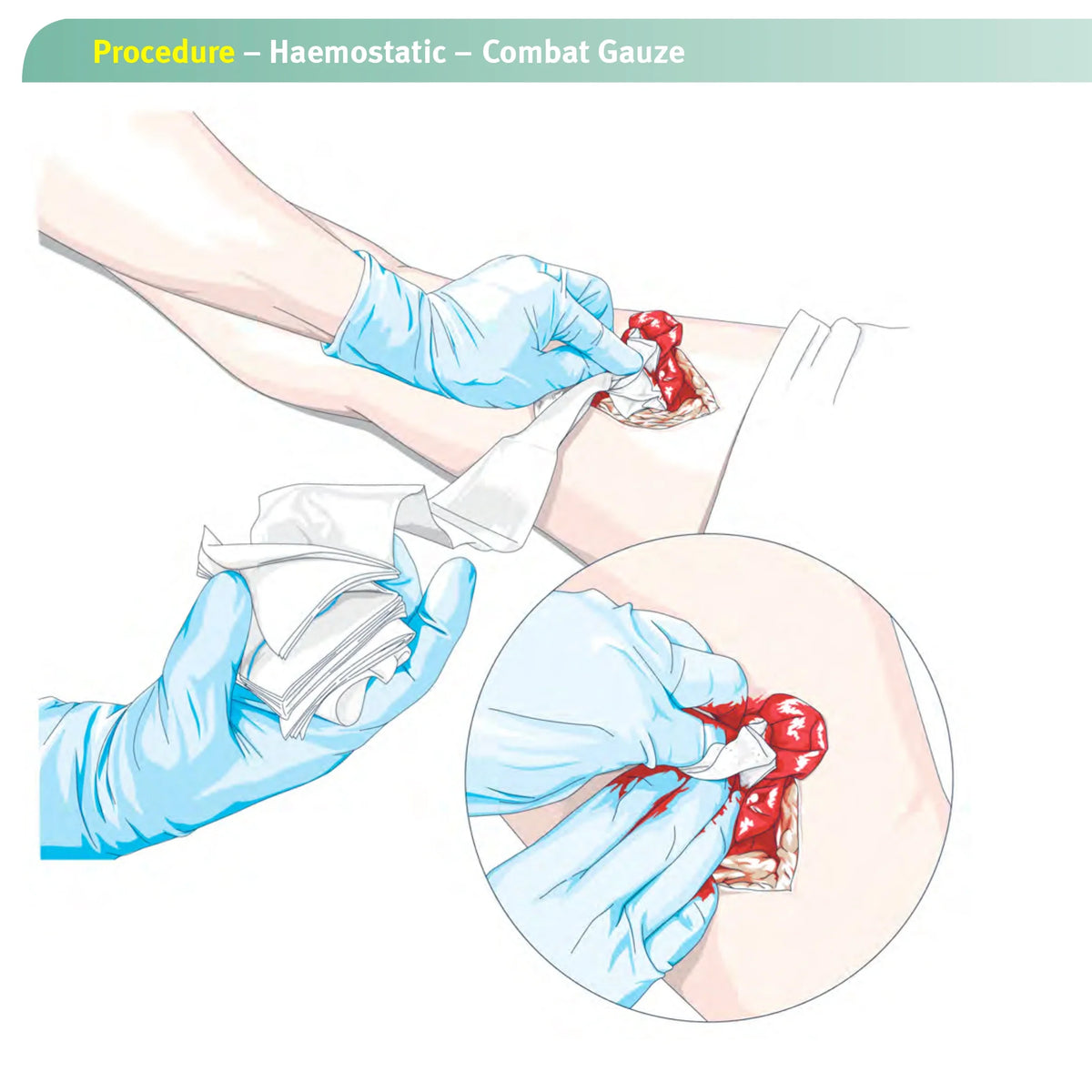 Illustration of a medical procedure using haemostatic combat gauze on a wound.