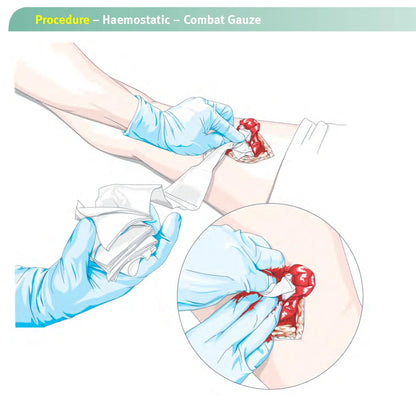 Illustration of a medical procedure using haemostatic combat gauze on a wound.